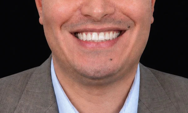 Après Invisalign et facettes E-Max Tunisie : sourire aligné