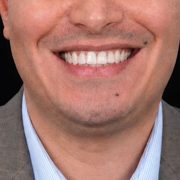After Invisalign and E-Max veneers Tunisia: aligned smile