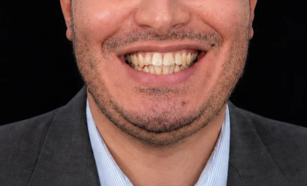 Avant Invisalign et facettes Tunisie : dents désalignées