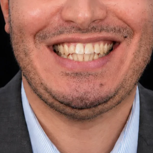 Before Invisalign and veneers Tunisia: misaligned teeth
