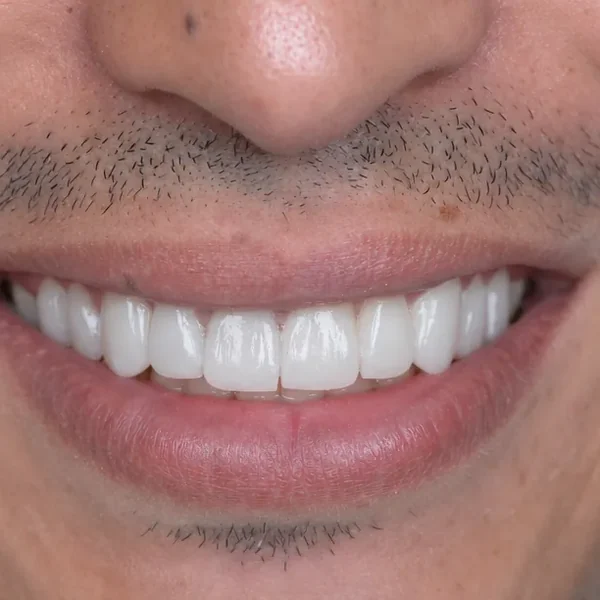 After 10 E-Max Veneers Tunisia result