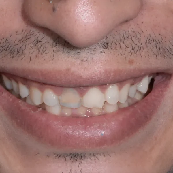 Before 10 E-Max Veneers Tunisia