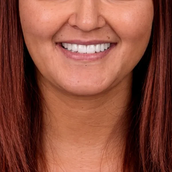 After 18 E-Max Veneers Tunisia result