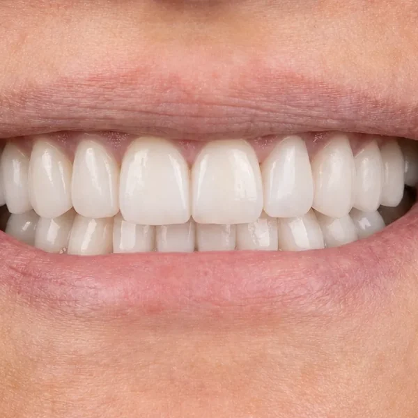 After 20 E-Max Veneers Tunisia result