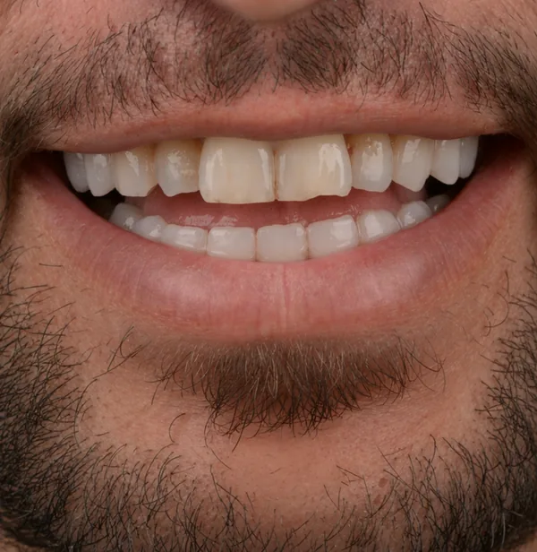 Avant 4 Couronnes Zircone + 6 Facettes Tunisie