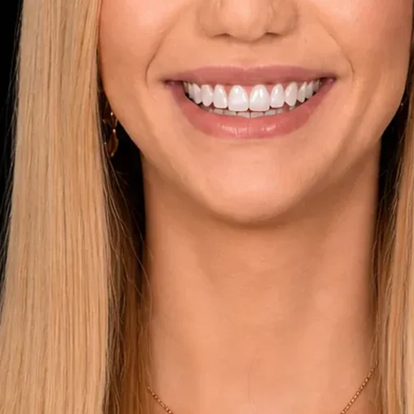 After 10 E-Max No-Prep Veneers Tunisia result