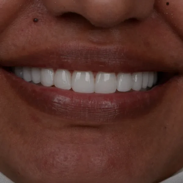 After 10 E-Max Veneers Tunisia result