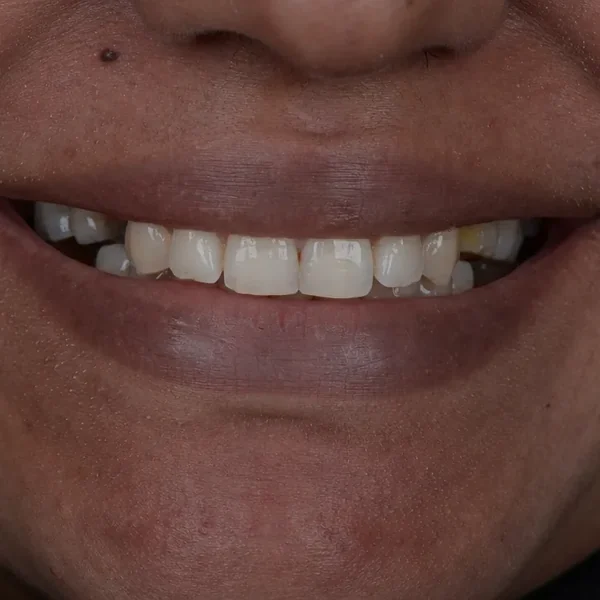 Before 10 E-Max Veneers Tunisia