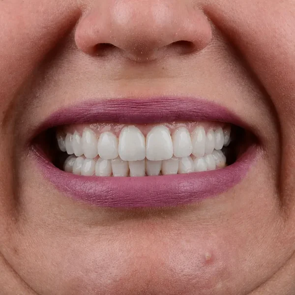 After 20 E-Max Veneers Tunisia result