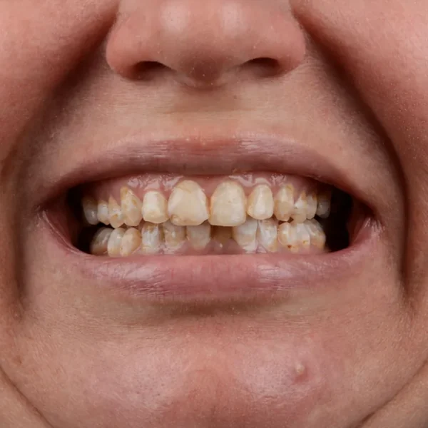 Before 20 E-Max Veneers Tunisia
