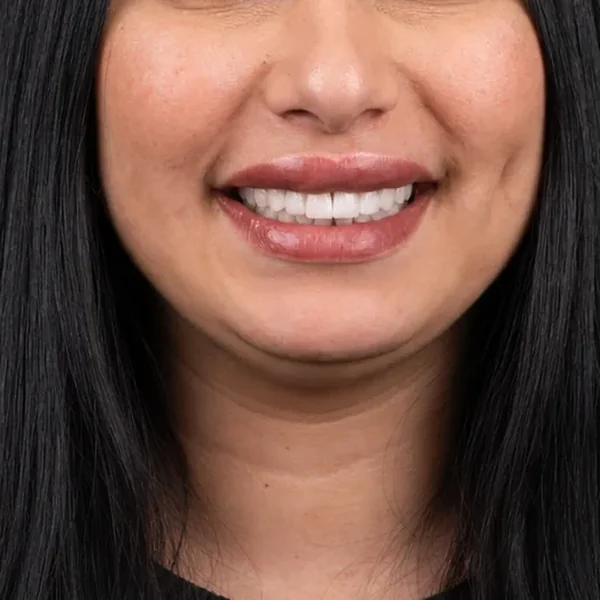 After 18 E-Max Veneers Tunisia result