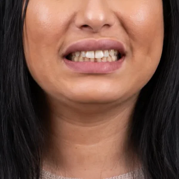 Before 18 E-Max Veneers Tunisia