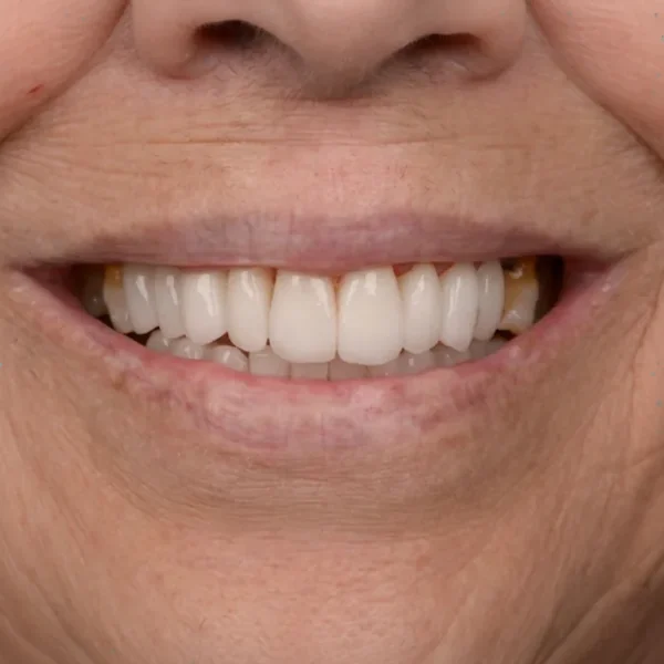 After 20 E-Max Veneers Tunisia result