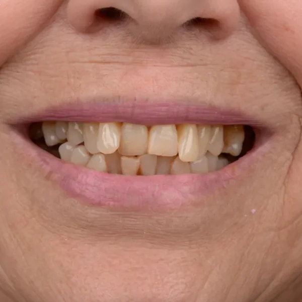 Before 20 E-Max Veneers Tunisia