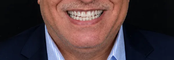 After zirconia crowns Tunisia result