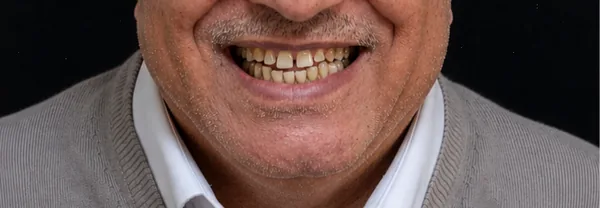 Before zirconia crowns Tunisia